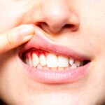 ¿Te sangran las encías? Causas, mitos y el plan definitivo para recuperarlas